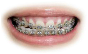 Preview for Diamond-braces-luxury-smile-mouths-sticker-9207f
