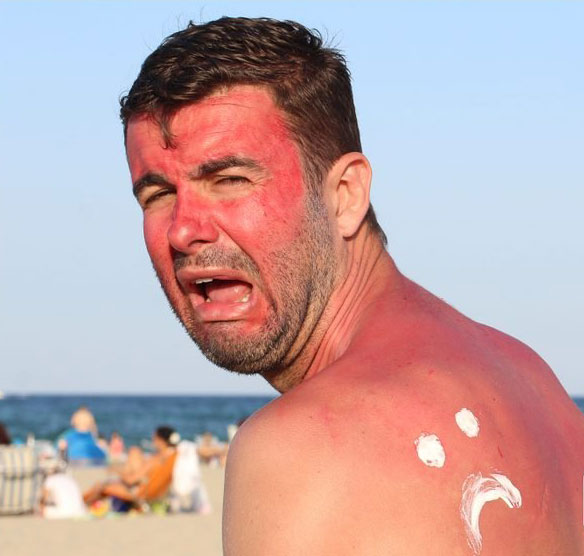 Preview for Sunburn-beach-safety-summer-meme-background-b9fa7