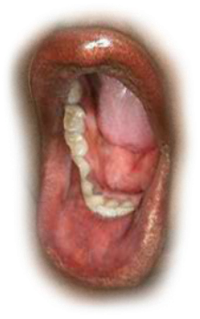 Close-up of an open mouth with white patches on the tongue
